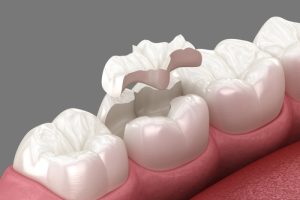dental inlay