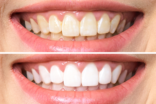 teeth whitening before & after