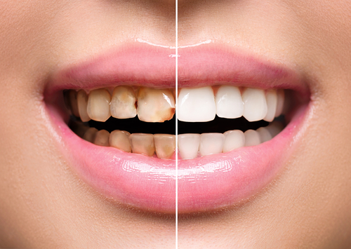 before and after teeth whitening