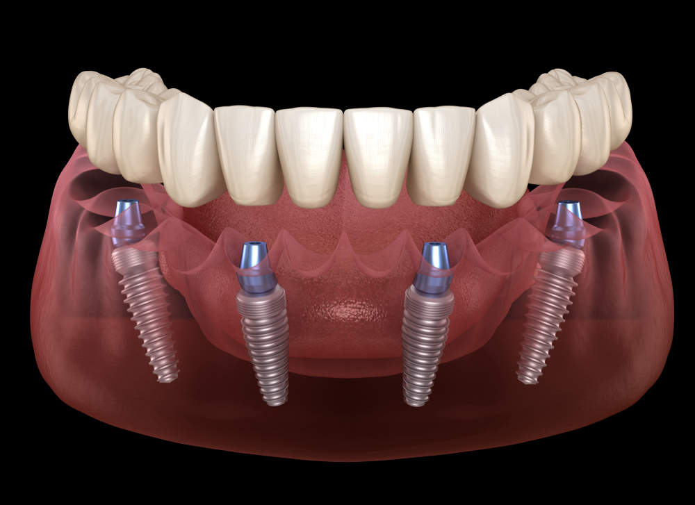 all on 4 dental implants 