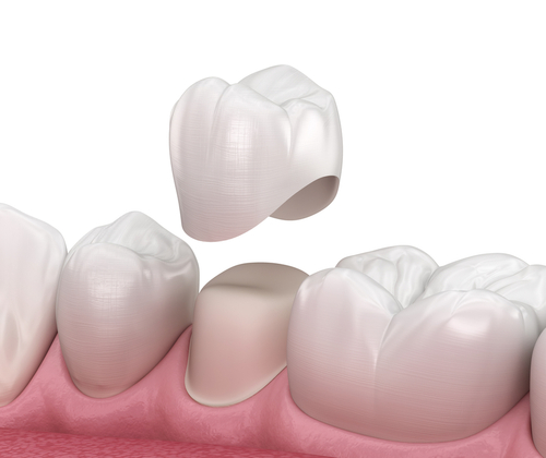 dental crown
