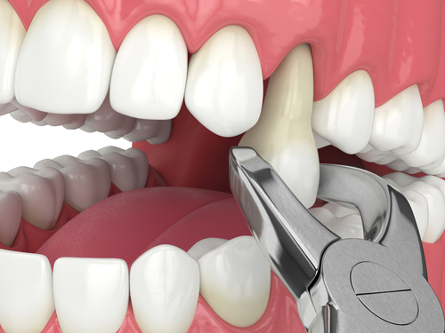 Lower,Jaw,With,Tooth,Extracted